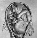 "Foetus in Utero" (1774), William Hunter. Wellcome Collection.